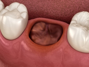 مراقبت های پس از کشیدن دندان