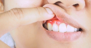 لق شدن دندان ها در بزرگسالی