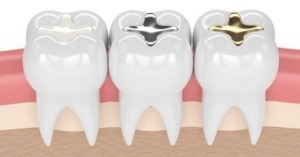  روشهای جایگزینی دندان از دست رفته