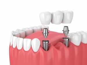  روشهای جایگزینی دندان از دست رفته