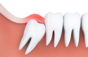 بهبودی پس از کشیدن دندان عقل
