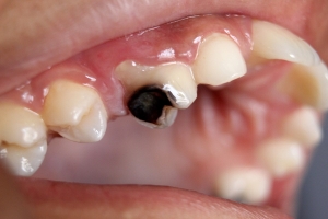 علت سیاه شدن دندان