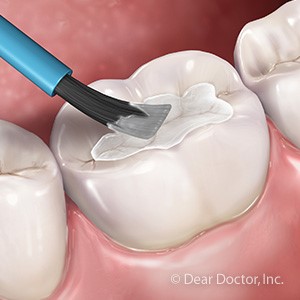 اثرات نوشابه بر دندان