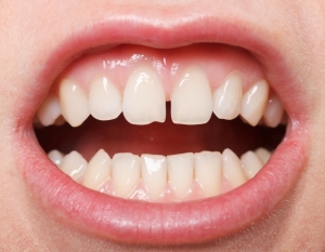 دیاستما یا فاصله بین دندان ها