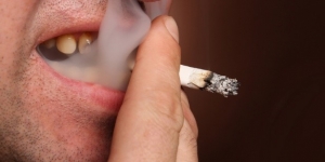 از بین بردن اثرات سیگار روی دندان