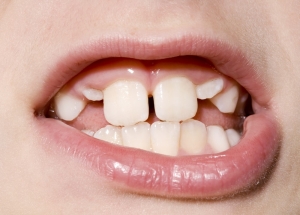 رشد دندان در کودکان