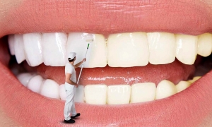 مراقبت های اساسی پس از انجام بلیچینگ دندان