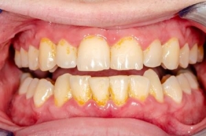 تارتار دندان 
