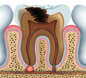  التهاب پالپ دندان