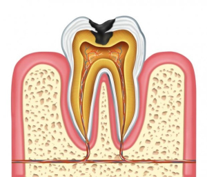  التهاب پالپ دندان