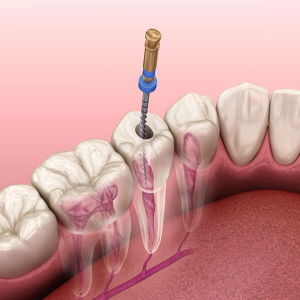  درمان ریشه دندان