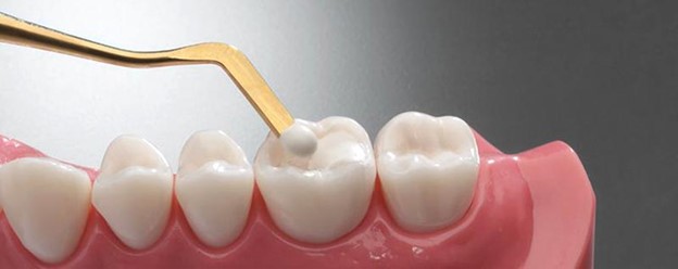 پر کردن دندان با کامپوزیت یا آمالگام