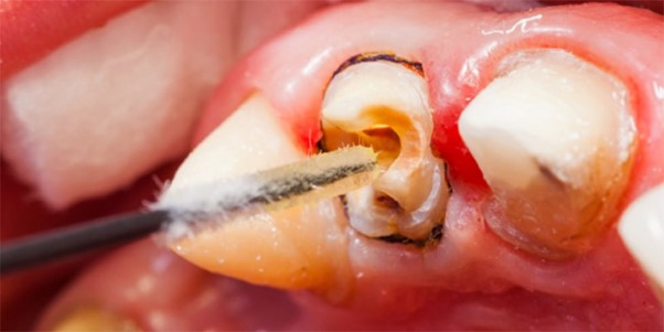 طول عمر دندان عصب ‌کشی شده
