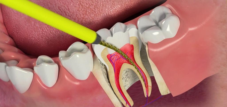 طول عمر دندان عصب ‌کشی شده