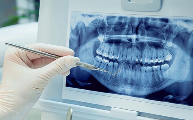 تصاویر رادیوگرافی در عصبکشی دندان