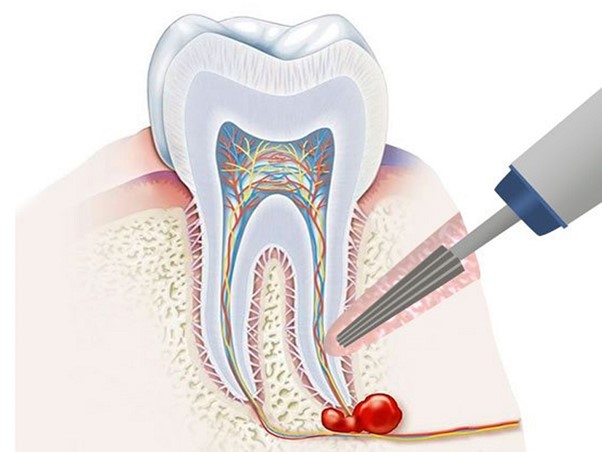 مشکلات بعد از عصبکشی دندان
