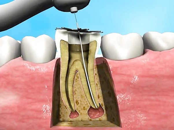 مشکلات بعد از عصبکشی دندان